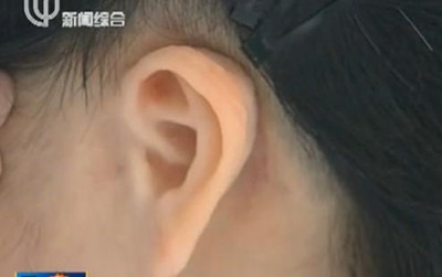 小伙左耳缺失 医生种植3D打印人耳仅需几分钟