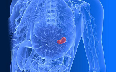 5年研究6693位患者，NEJM最新研究帮助全球千万乳腺癌患者告别不必要化疗