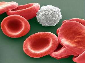 Nature：利用白血病干细胞LSC17评分可预测AML病人治疗反应