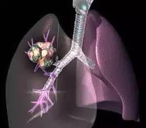 布洛芬可以降低吸烟者肺癌死亡的风险
