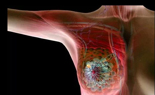 诺华新药Kisqali获FDA批准 一线治疗HR+/HER2-晚期或转移性乳腺癌