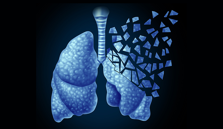 肺癌耐药机制及临床诊疗策略制定