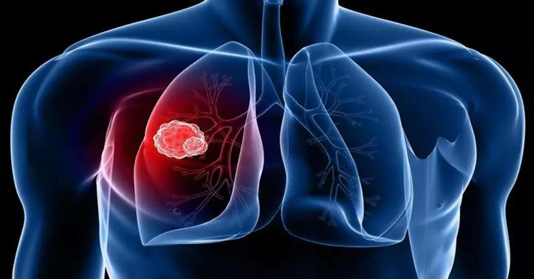 【STTT】新型致癌基因！浙江大学最新研究：发现非小细胞肺癌潜在治疗策略