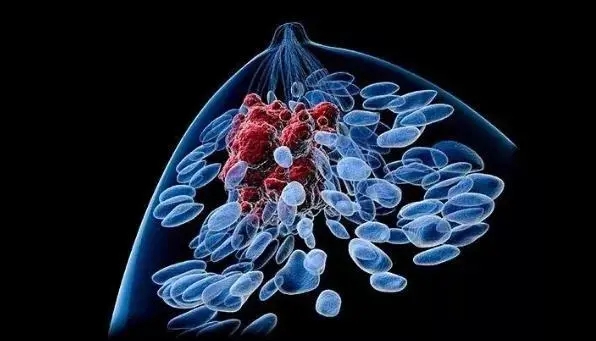 再取进展！中国医学科学院发现“最毒乳腺癌”潜在诊断生物标志物和治疗新靶点