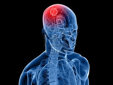 J Neurosci：科学家发现不同的脑瘤或存在相同的起源