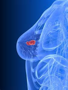 科学家鉴别出治疗三阴性乳腺癌的潜在靶点