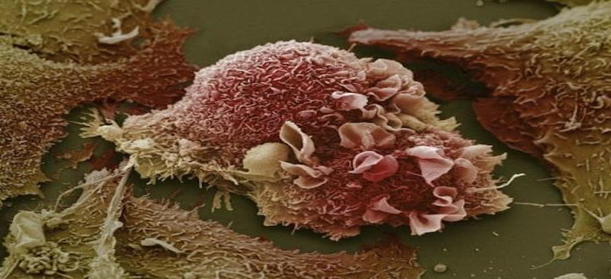 科学家发现了肺癌细胞的自毁开关