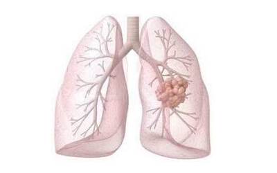 J TRANSL MED：肺癌与循环调节性淋巴细胞