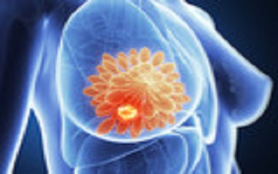 新放疗技术拓展乳腺癌治疗选择