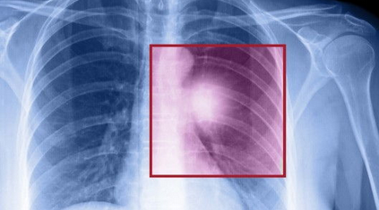 新型监测技术或可有效帮助肺癌个性化治疗