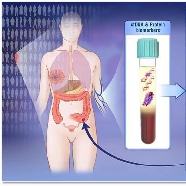 《科学》大突破!一次检测8种常见癌症!约翰霍普金斯大学重磅发现