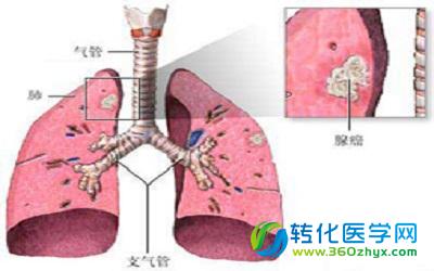 琥珀酸合成酶（ASS）缺陷或为肺神经内分泌癌个体化靶向治疗带来新的希望