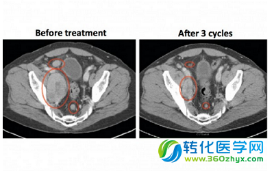 Science新闻：颠覆常规的癌症疗法