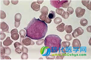 Blood：窥视白血病干细胞 助力新型靶向疗法的开发