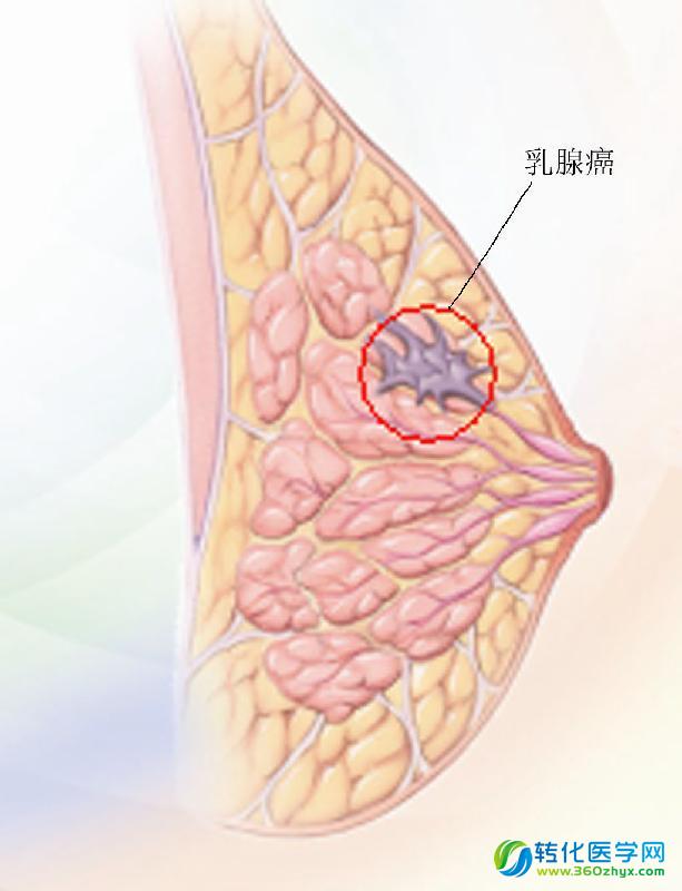 针对CDH1的研究发现，基因更够更好的评估遗传性胃癌的风险