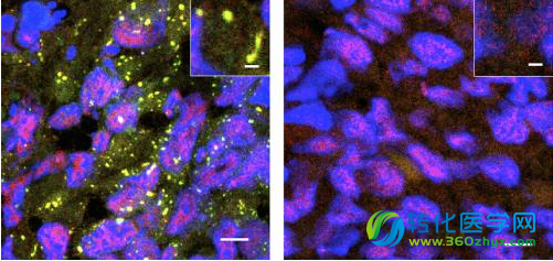 JCB：科学家发现蛋白应激颗粒或可促进癌症发生转移