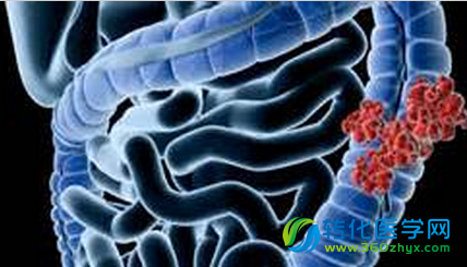 科学家或开发出治疗肠癌的新型个体化疗法