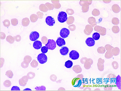 Nature：治疗B细胞急性淋巴细胞白血病的新疗法