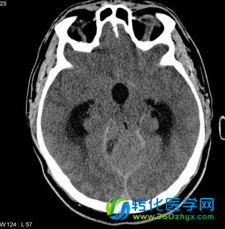 Devel Cell：科学家鉴别出治疗髓母细胞瘤的潜在药物靶点