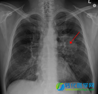 Stem Cells：科学家揭开抑制肺癌干细胞活性的分子机制