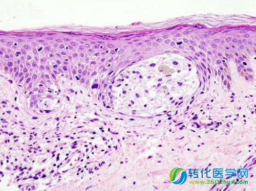 Cell Rep：科学家鉴别出了治疗耐药性黑色素瘤的新靶点