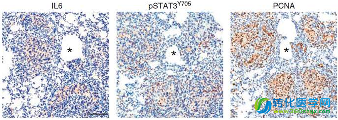 Cancer Discov：科学家发现耐药性前列腺癌的免疫标志物