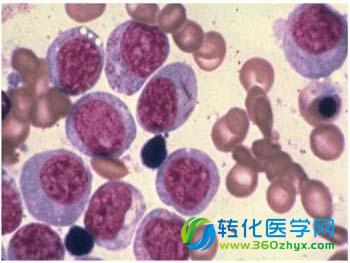 天津市肿瘤医院在儿童霍奇金淋巴瘤治疗方面实现突破