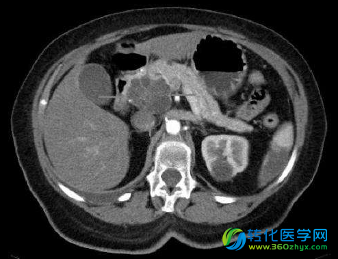 Nature：血液中的小颗粒分子或可用于进行早期胰腺癌的检测