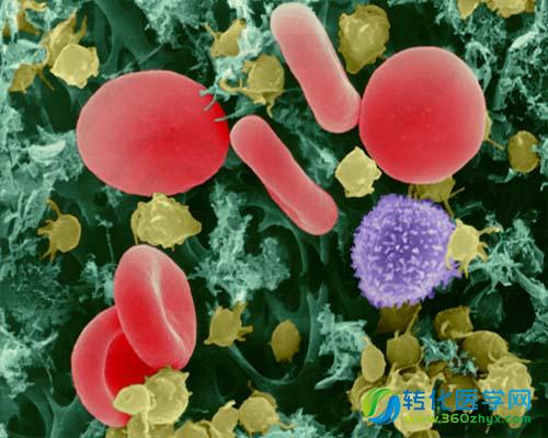 异基因造血干细胞移植治疗复发性霍奇金淋巴瘤获得成功