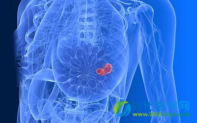 乳腺癌早期治愈率可达95%