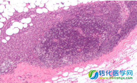 血管“门户”促进乳腺癌细胞通过血液扩散到全身