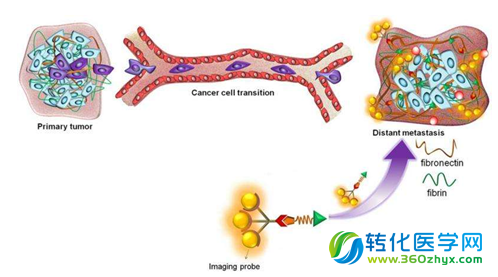 新型改进型MRI技术可有效检测乳腺癌的转移