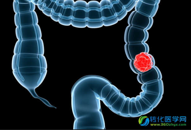 综述：直肠癌的精准化疗法及基因组进化蓝图
