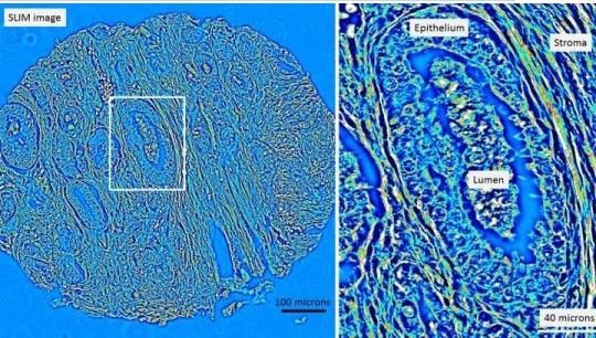 Scientificreports：前列腺癌复发检测新方法问世