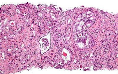 PNAS：致死性前列腺癌细胞或具有干细胞样特性