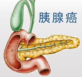 科学家将胰腺癌生存与四个基因联系起来