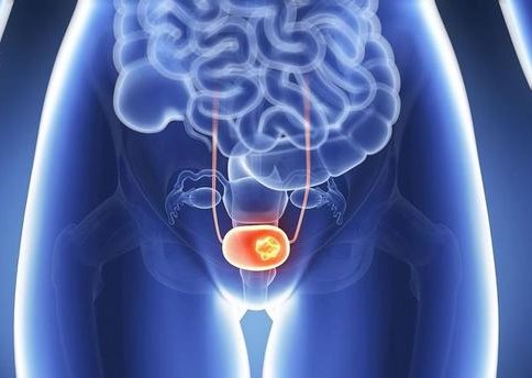 中国科学家首次利用膀胱癌患者尿液分离出并成功培养可稳定扩增传代的膀胱肿瘤细胞 