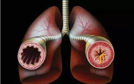 【热点】吸烟者和慢性阻塞性肺疾病(COPD)患者更易患COVID-19