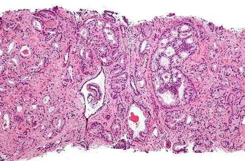 【Nature子刊】数学模型可预测前列腺癌适应性治疗结果