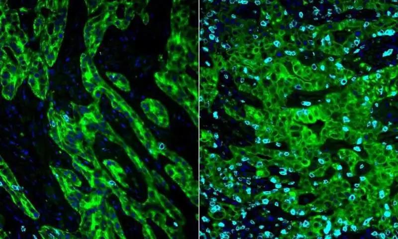 【Nature】新突破：胰腺癌治疗新方法——羟化氯喹+化疗