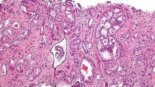【新进展】英国科学家发现了前列腺癌的新药物靶标！
