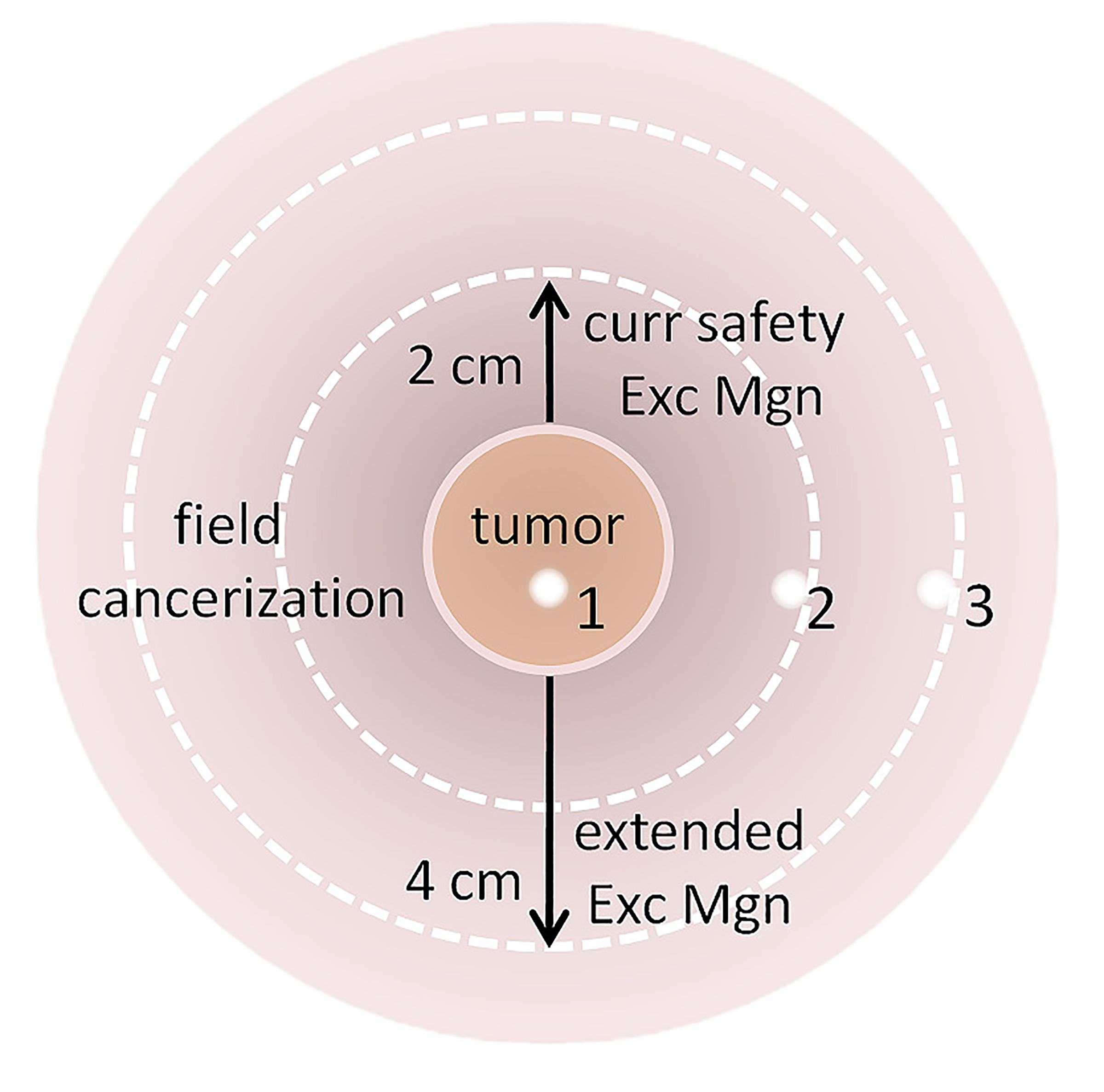 iFISH肿瘤组织与液体活检精准定位区域性癌变手术切缘及有效检测细胞型MRD