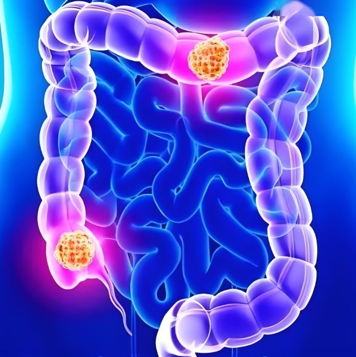 转移新机制！中国医科大学李丰团队：发现结肠癌治疗潜在靶点