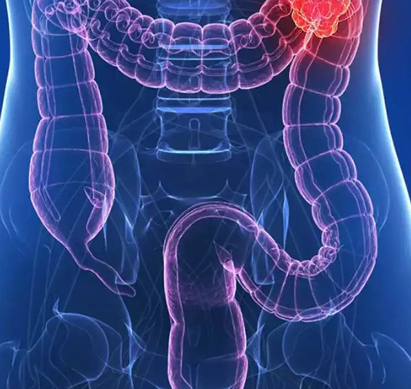 “纳米疗法”！中山大学合作发文：揭示结直肠癌有效治疗新策略
