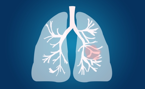 新见解！华中科技大学刘博团队：发现肺腺癌预后生物标记物和治疗新靶点