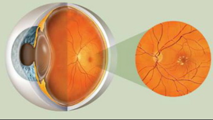 新型激光疗法可帮助减少眼部黄斑变性的发生